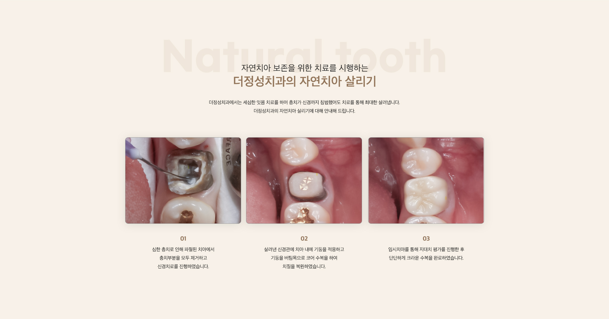 더정성치과의 자연치아 살리기